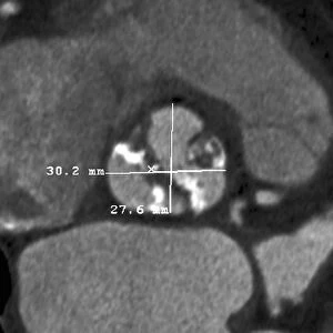 Calcified heart valve, CT scan