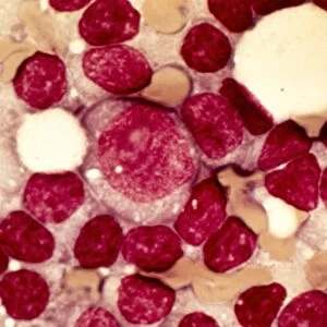 Chronic lymphocytic leukaemia, micrograph