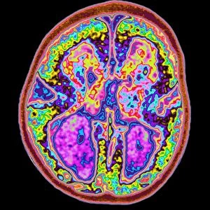 Coloured MRI brain scan showing lissencephaly