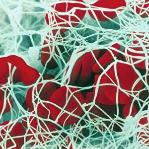 Coloured SEM of red blood cells forming a clot