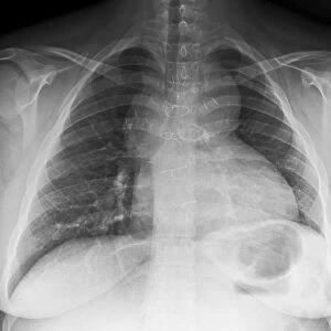 Congenital heart disease, X-ray C017 / 8020