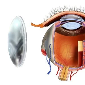 Contact lens and eye anatomy, artwork C016 / 6572