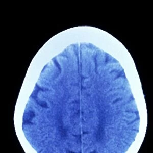 CT brain scan of dementia