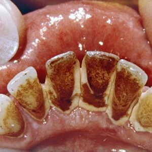 Dental plaque and tartar