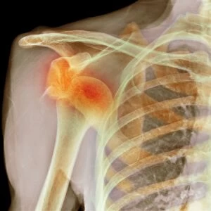 Dislocated shoulder, X-ray F008 / 3441