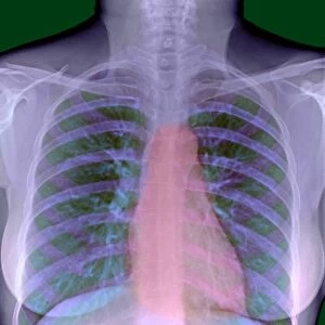 Heart, chest X-ray