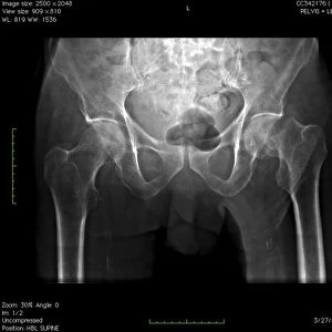 Hip fracture, digital X-ray