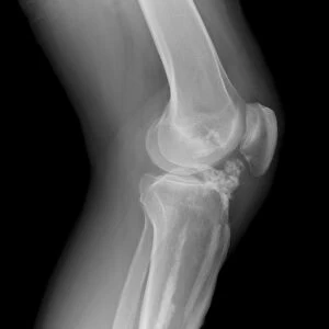 Melorheostosis of the knee, X-ray C017 / 7145