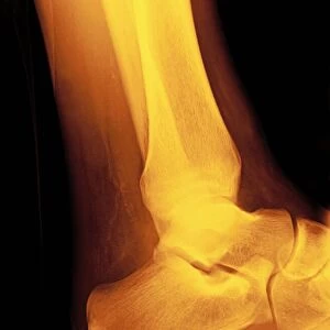 Normal ankle joint, X-ray