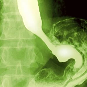 Normal oesophagus and stomach, X-ray