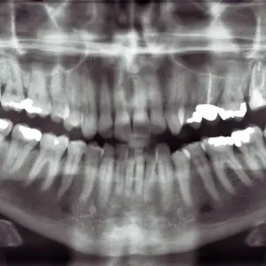 Xray