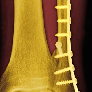 Pinned ankle fracture, coloured X-ray