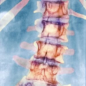 Pinned curved spine, X-ray