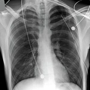 Pneumothorax treatment, X-ray