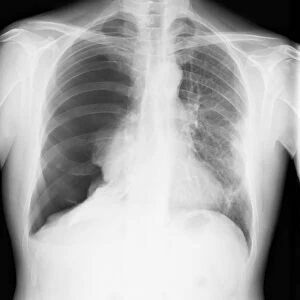 Pneumothorax, X-ray C017 / 7148