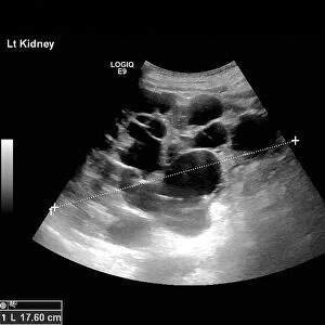 Polycystic kidneys, ultrasound scan