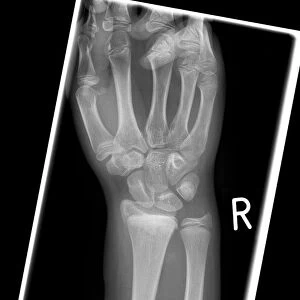 Salter Harris fracture, X-ray C017 / 7507