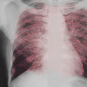 Sarcoidosis of the lungs, X-ray