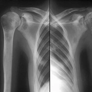 Secondary bone cancer, X-ray C018 / 0594