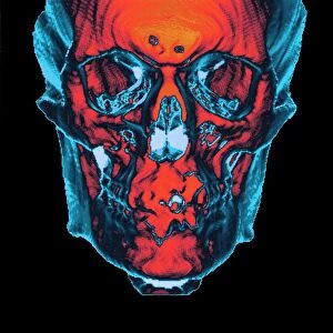 Skull, CT scan