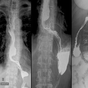 Throat cancer, X-rays