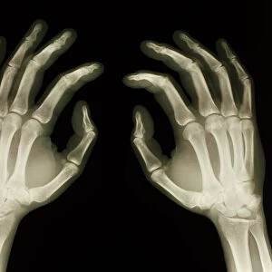 X-ray of healthy human hands