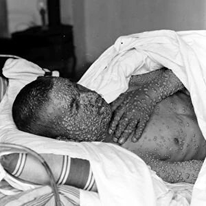 SMALLPOX PATIENT. Smallpox patient in a hospital bed, early 20th century
