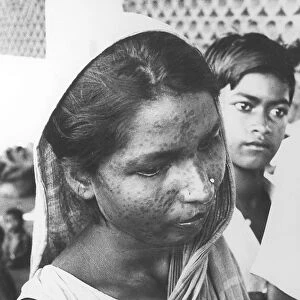 Indian woman with Smallpox scars