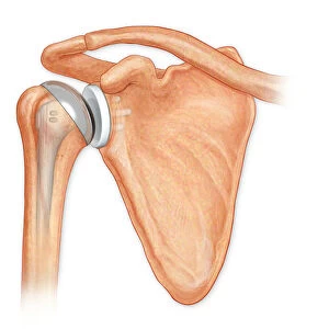 Anterior view total shoulder joint repair