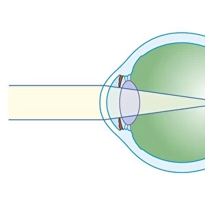 Cross section biomedical illustration of myopia