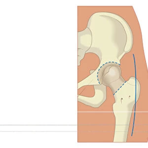 Digital illustration of prosthetic hip joint replacement
