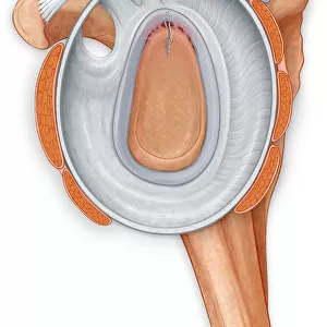 Lateral view of the shoulder joint showing the repair to the labrum