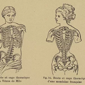 Comparison of the shape of the chest and ribcage of the Venus de Milo with that of a late 19th Century French socialite (engraving)
