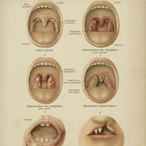 Diseases and disorders of the mouth and throat (colour litho)