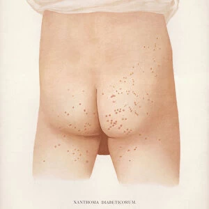 Diseases of the Skin: Xanthoma Diabeticorum (colour litho)