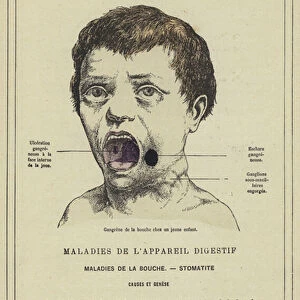 Gangrene de la bouche chez un jeune enfant (colour litho)