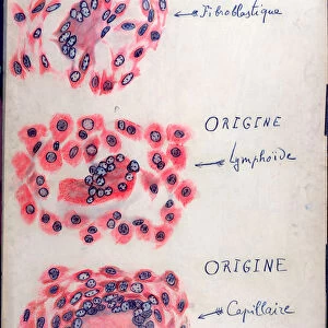 Principle tuberculosis follicles (pen & ink on paper)