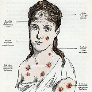 Young woman with syphilis presenting with plaques and pustules characteristic of the diseasee Engraving from " La nature et l'homme" by Rengade 1881 Private collection
