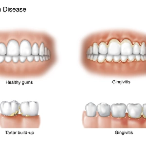 Comparison of healthy gums versus gingivitis
