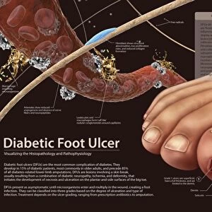Histopathology and pathophysiology of diabetic food ulcers