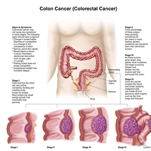 Medical illustration depicting the different stages of colon cancer