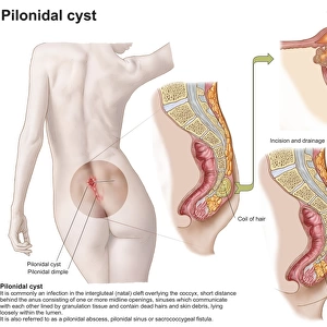 Medical ilustration of a pilonidal cyst near the natal cleft of the buttocks