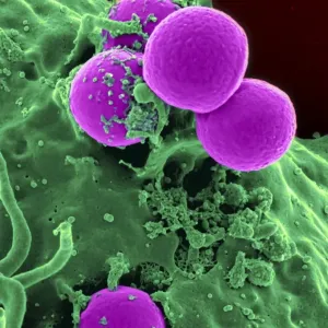 Scanning Electron Micrograph Print of Neutrophil Ingesting MRSA Bacteria