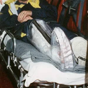 Ally McCoist with broken leg arriving at Edinburgh Airport 1994