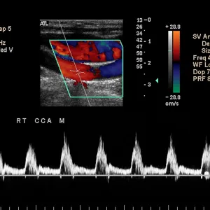 Carotid Duplex Ultrasound Print Carotid Duplex Ultrasound Print