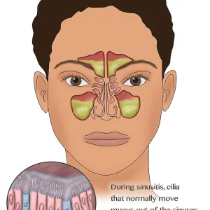Sinus Anatomy During a Sinus Infection Print Sinus Anatomy During a Sinus Infection Print