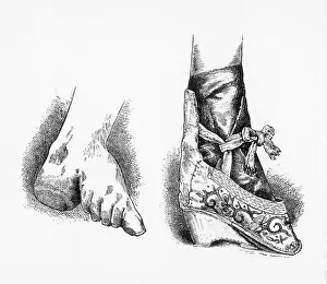 Chinese Foot-Binding Print: Bound Foot Encased in a Traditional Shoe