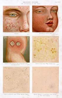 Eruptive Fevers - Plate 6 Eruptive Fevers - Plate 6