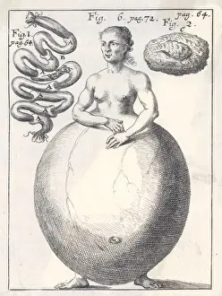 19th Century Medical Art Prints: Hideous Deformity