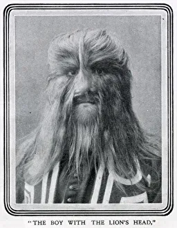 Stephan Bibrowski (1890 - 1932), know as Lionel the Lion-faced Man Stephan Bibrowski (1890 - 1932), know as Lionel the Lion-faced Man